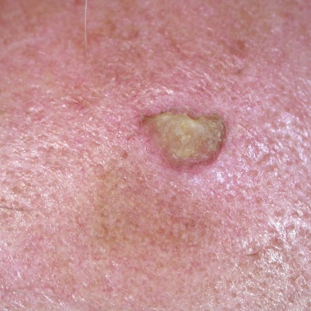 Seborrhoeic keratoses - Dr Jonathan Bowling